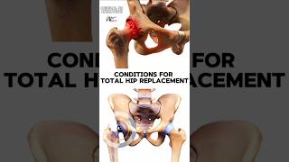 Conditions for Total Hip Replacement medical animation 3d short Biology with Aliya [upl. by Tepper]