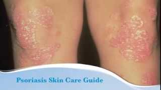 Psoriasis skin care guide [upl. by Adianes]