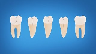 Understanding Cracked Tooth Treatment and Symptoms [upl. by Carmencita671]