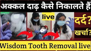 Akkal Dadh Kaise Nikalte Hai🦷 Wisdom Tooth Removal अकल दाढ़ निकलवाए या नहीं दाढ़ निकलने का खर्चा [upl. by Vipul]