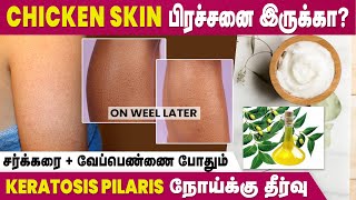 Affected By Keratosis Pilaris Disease  Home Remedies To Cure Chicken Skin  IBC Mangai [upl. by Yhtir]