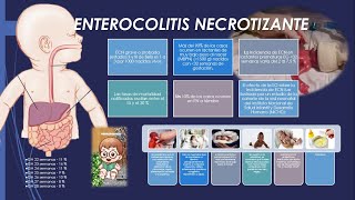 ENTEROCOLITIS NECROTIZANTE CAPITULO 1 [upl. by Keyte]