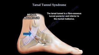 Tarsal Tunnel Syndrome causes and treatment [upl. by End480]