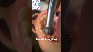 Central incisor cosmetic filling dentist dentalclinic toothdental [upl. by Furlani522]