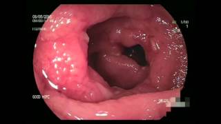 Double Balloon Enteroscopy in Crohns disease [upl. by Suryt417]