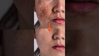 Black Spots Removal By Laser  Dark Spots on Face Treatment  Skin Care Tips  Dr Anvika Mittal [upl. by Wrennie]