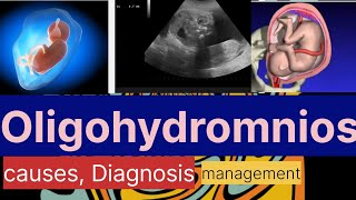 Oligohydramnios causes Diagnosismanagement Dr Naima Bano [upl. by Rosemare]