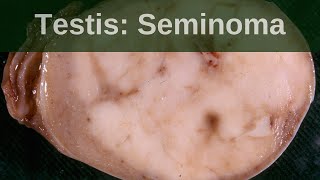 Testicular germ cell tumours  Seminoma  Pathology mini tutorial [upl. by Hildagard]