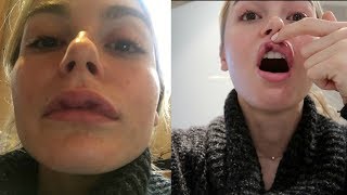 GETTING MY LIPS DONE 👄  MY LIP FILLER EXPERIENCE BEFORE AND AFTER 💉 [upl. by Pleasant]