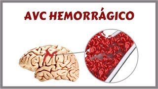 Acidente Vascular Cerebral Hemorrágico  AVCH [upl. by Conney]