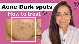 Acne Dark Spots  हिंदी  How to treat  serum cream recommendations  Dermatologist  Dr Aanchal [upl. by Pironi]