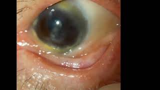 Ocular Cicatricial Pemphigoid [upl. by Ahsiela]