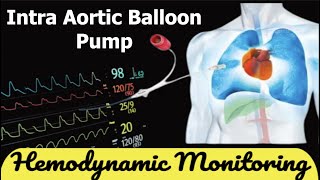 Intra Aortic Balloon Pump [upl. by Oly]