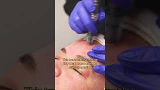 Hows a Micro Needling Skin Treatment microneedling [upl. by Leahcimaj]