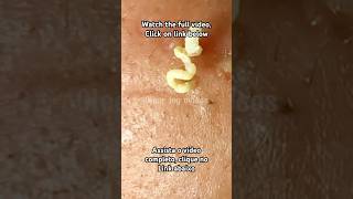 Big Cystic Acne Blackheads ExtractionBlackheads amp Milia Whiteheads Removal Pimple Popping [upl. by Llenaj383]