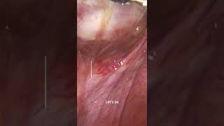 Ovarian Endometriosis amp Adhesions How to See at Surgery amp Ultrasound endometriosis ultrasound [upl. by Ahsuas700]