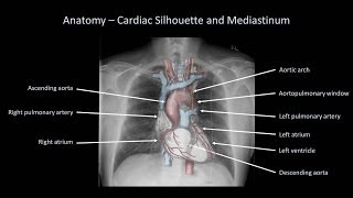 How to Interpret a Chest XRay Lesson 2  A Systematic Method and Anatomy [upl. by Manouch]