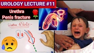 Urology surgery lecture 11 urethral stricture 🩸🩸catheter injury Treatment urthroplasty [upl. by Eikcir]