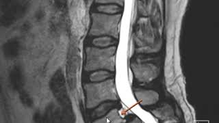 Pars fractures [upl. by Brinkema]