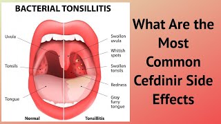 What Are the Most Common Cefdinir Side Effects [upl. by Seidel]