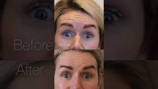 Botox before and after VIDEOs tell the real story [upl. by Essirehs]