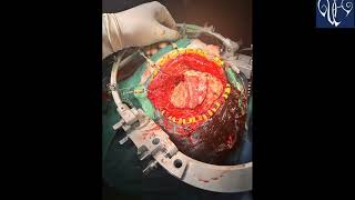 PLANUM SPHENOIDALE MENINGIOMA EXCISION  DR VIJAYMAHANTESH PUJARI [upl. by Slack]