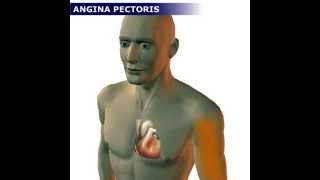 Angina Pectoris [upl. by Aileda]