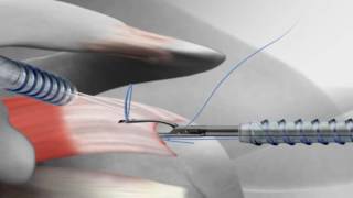 Rotator Cuff Repair with Arthrex® SutureBridge™ [upl. by Nannerb436]