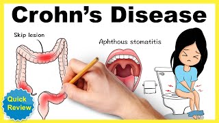 Crohns disease Symptoms pathophysiology diagnosis treatment mnemonic Quick review [upl. by Marfe]