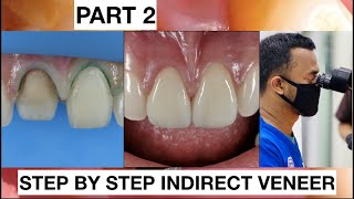 Step by Step 2 Indirect Veneer with Discoloration Tooth Part 2  General Dentist Griya RR [upl. by Viradis]