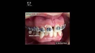 TIMELAPSE  BRACES  Malocclusion braces trending dentistry anantnag orthodontics youtube [upl. by Marcelline]