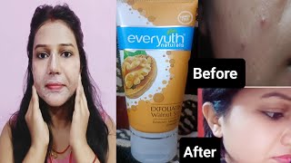 Everyuth Face Scrub Review Best Scrub For Remove Blackheads And Whiteheads everyuth  Best Scrub [upl. by Catha]