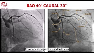 Coronary angiography standard views [upl. by Nyleak595]