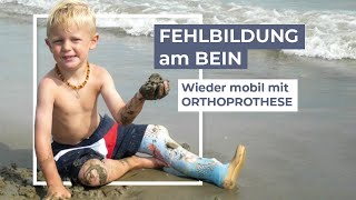 Dysmelieangeborene Fehlbildung  Versorgung mit Orthoprothesen [upl. by Naejarual227]