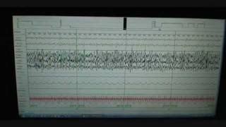 Sleep Study Scoring on Person with Normal Sleep Polysomnograph [upl. by Sidky]