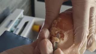 Removing Extremely Hard Foot Callus 🦶 The right way to remove foot callus FULL TREATMENT 10 [upl. by Hnid176]