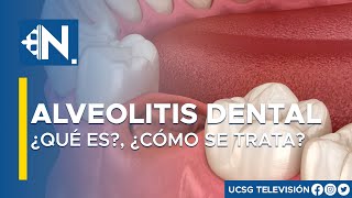 Alveolitis dental ¿Qué es y cómo se trata l Lo mejor del día Viva Mejor TV [upl. by Suiluj]