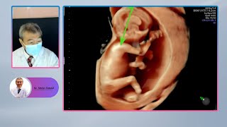 Your Babys Gender Revealed 13 Weeks Into Your Pregnancy [upl. by Amil]