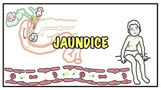 Approach to Jaundice  types and causes of hyperbilirubinemia investigations [upl. by Nnaeed115]