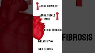 Understanding Atrial Fibrillation Causes Symptoms and Treatment [upl. by Hayidan]