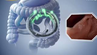 Endoscopic Procedures in GastroenterologyMalayalam Informative VlogNurses role in Endoscopypart 2 [upl. by Hax]