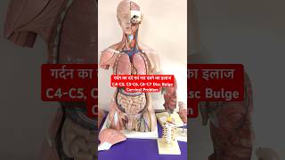 Whatsapp Number7987128051for treatment Cervical Pain गर्दन के दर्द का ईलाज C4C5C6C7 Disc bulge [upl. by Novahs712]