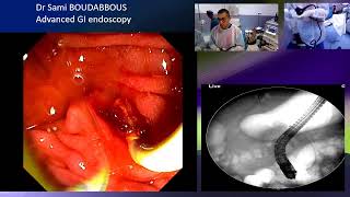 ERCP for acute cholangitis [upl. by Navis]