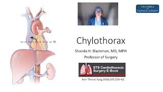 Chylothorax [upl. by Elokin]