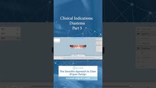 Clinical Indications Diastema Part 5 [upl. by Aihseya]