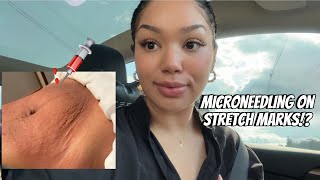 Microneedling on Stretch Marks  Vlog pt 1 [upl. by Terej]