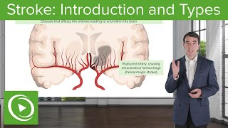 Stroke Introduction and Types  Clinical Neurology [upl. by Llenrahs154]