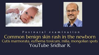 Common benign skin rash in the newborn Dr Sridhar K [upl. by Boles102]