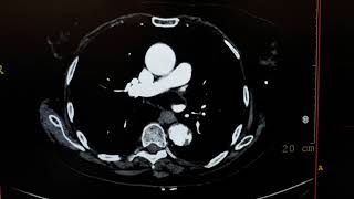 Abdominal Aortic Aneurysm ct [upl. by Jansson]