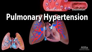 Pulmonary Hypertension Animation [upl. by Bellew]